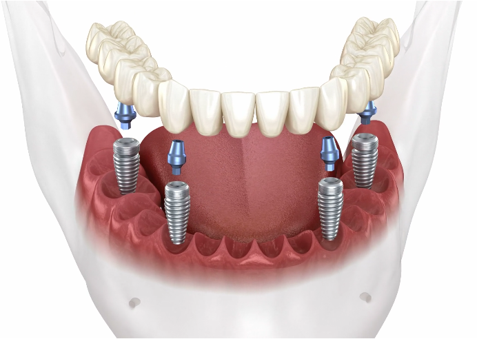 Full arch dental implant procedure