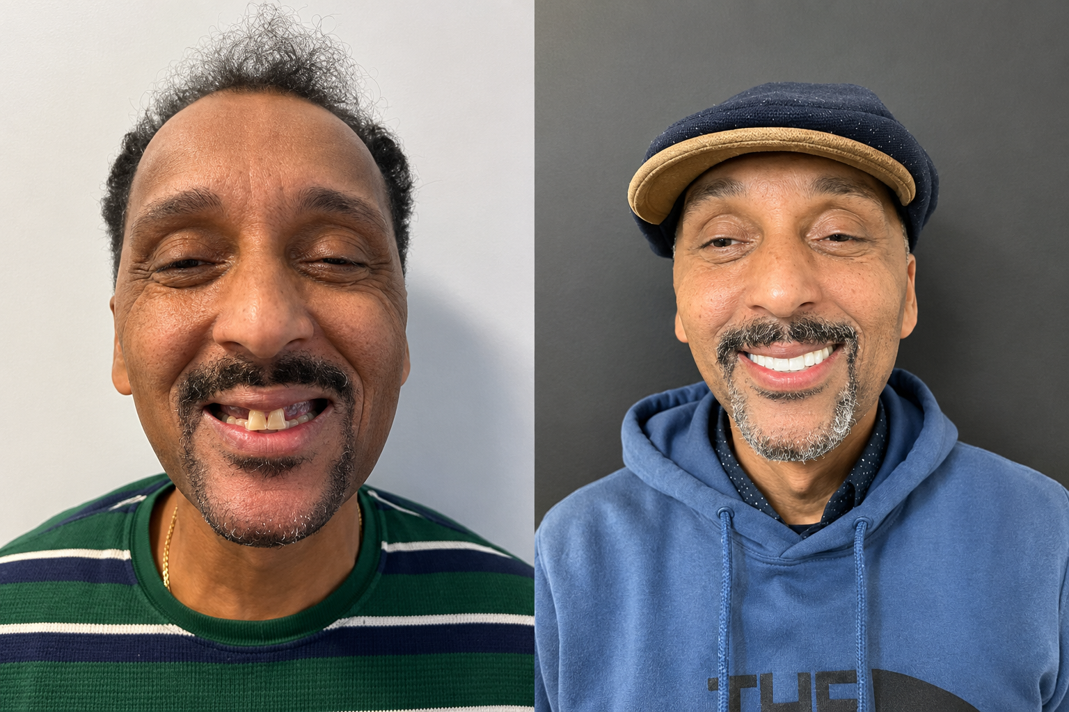 Before and after dental implant transformation